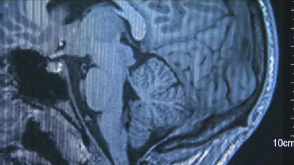 New risk factors identified in early-onset dementia