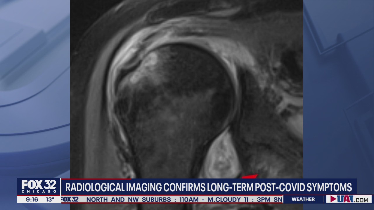 Radiological imaging confirms presence of longterm post-COVID symptoms