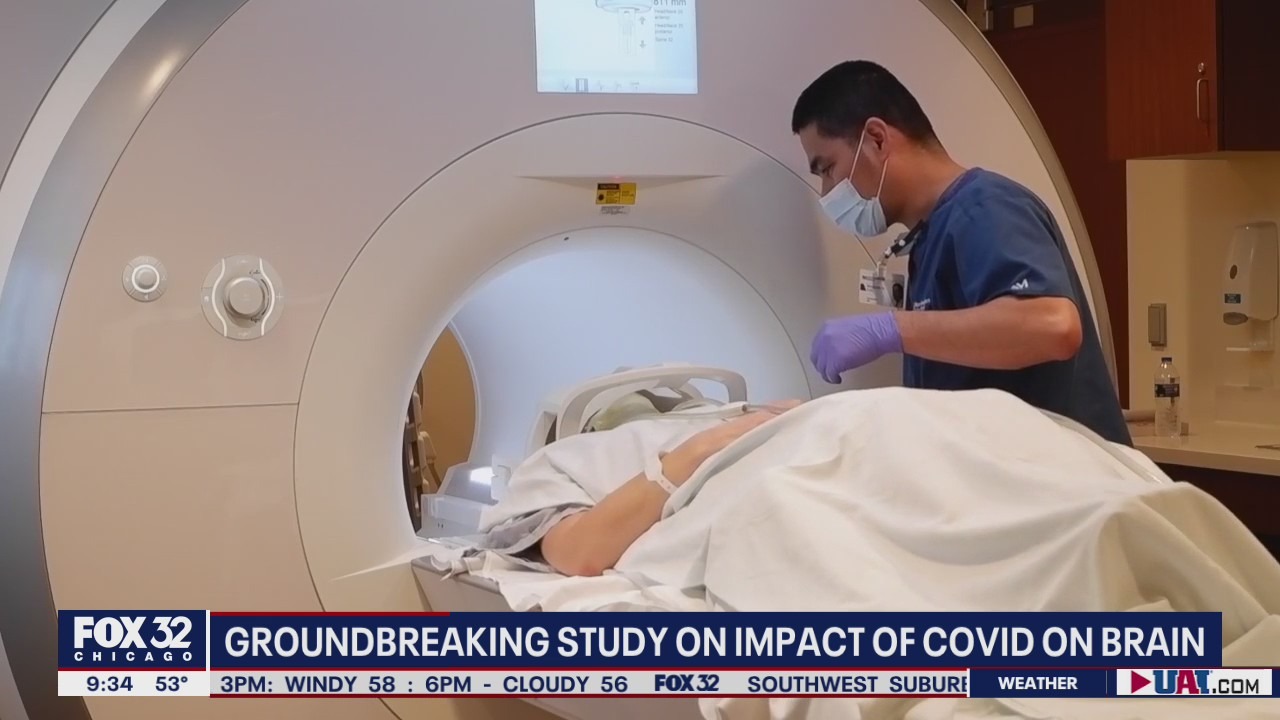 Brain fog found as most frequent neurologic symptom of COVID long haulers