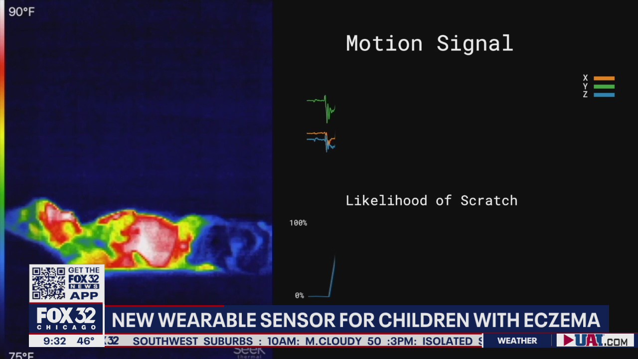 New sensor to help children with eczema stop scratching