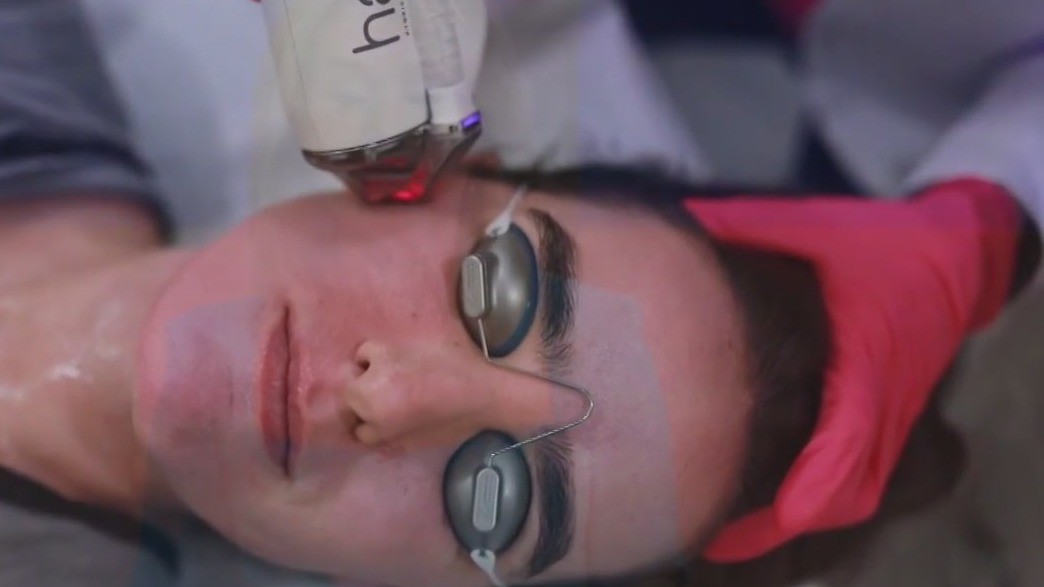 Halo laser treatment