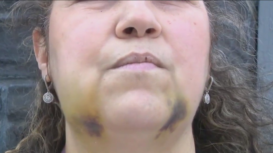 Victim of random punch attack speaks out