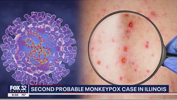 2nd probable monkeypox case reported in Illinois