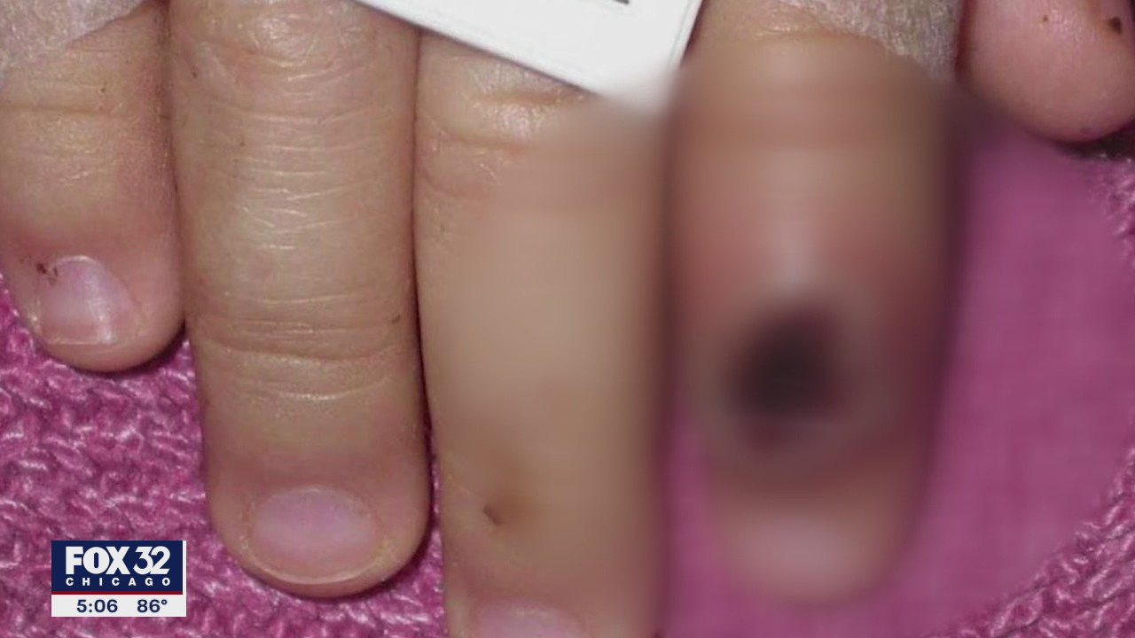 7 confirmed monkeypox cases in Chicago