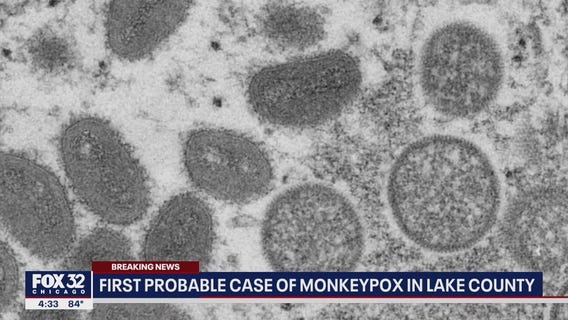 Monkeypox moves into Lake County: First probable case reported