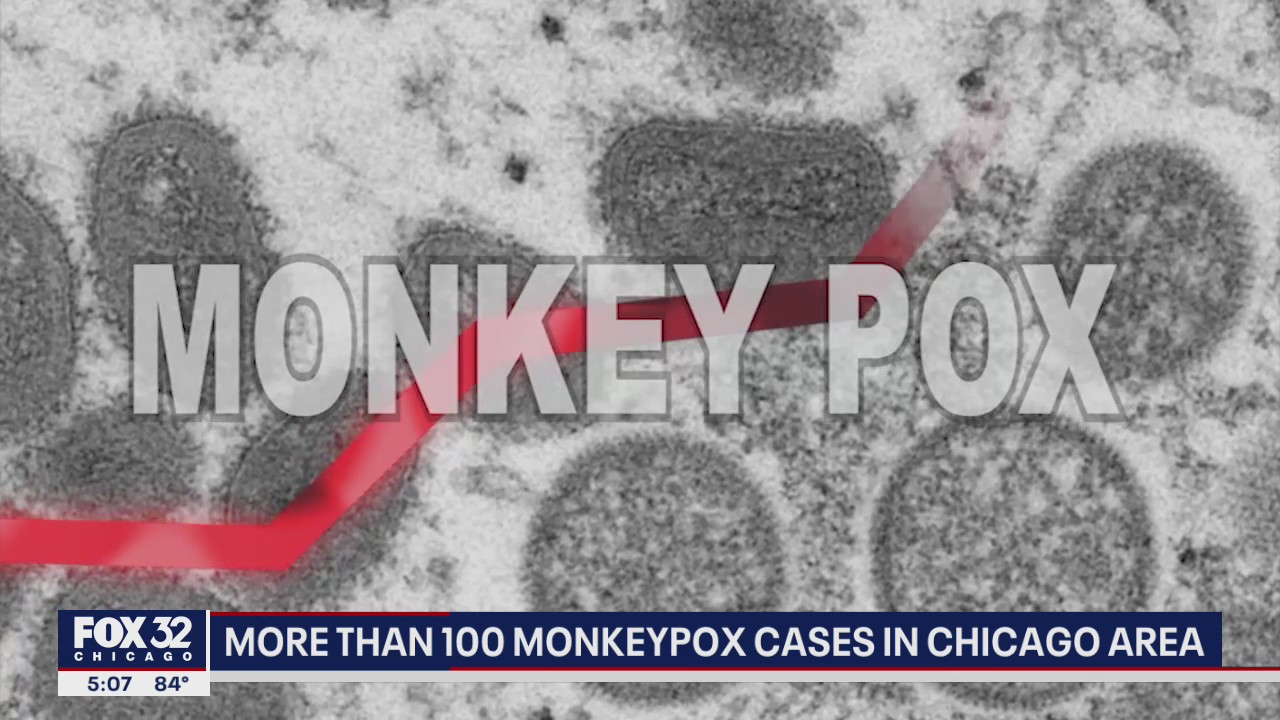 More than 100 monkeypox cases in Chicago area