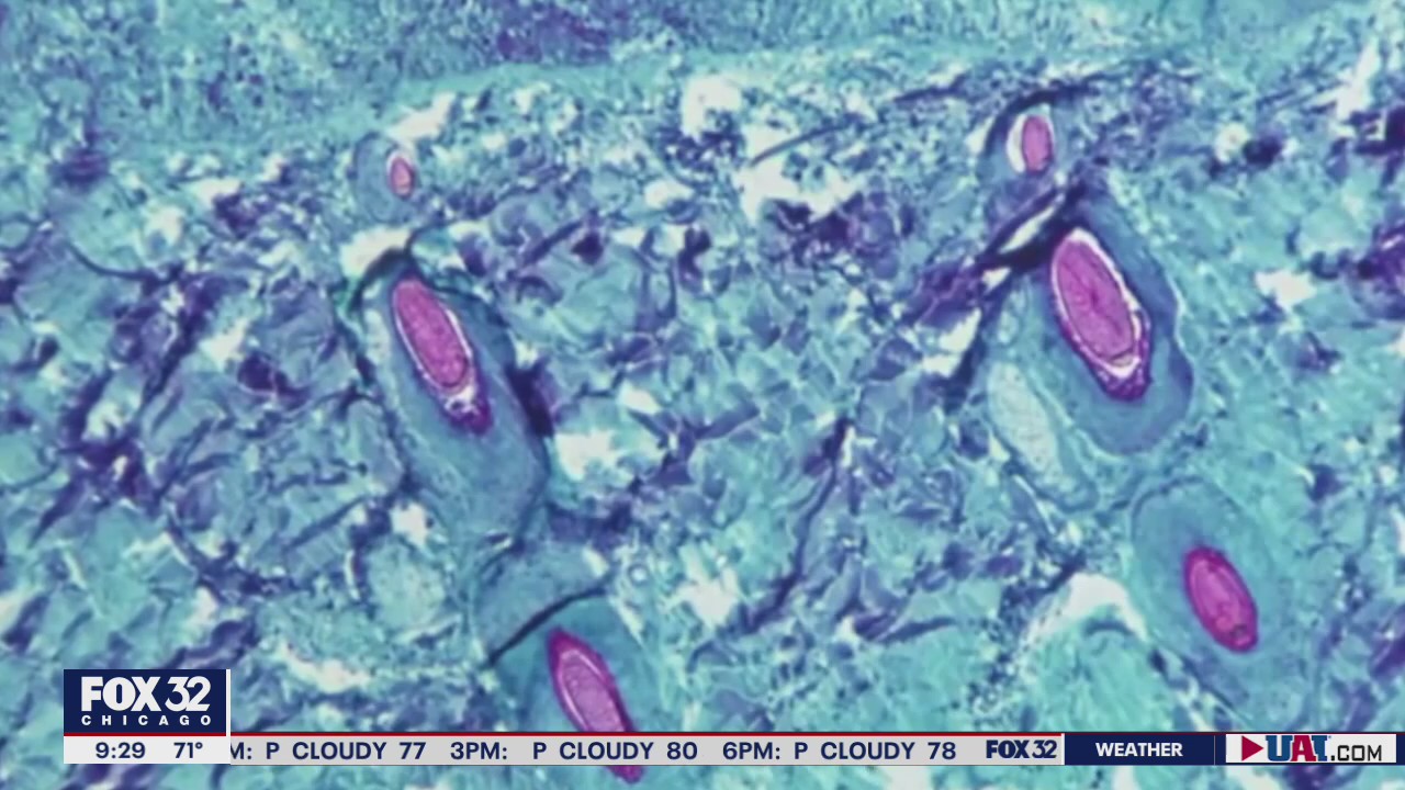 Monkeypox case reported at Cook County Jail