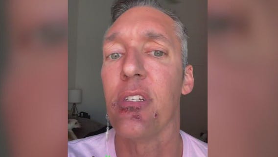 Man suffering with monkeypox speaks out as cases rise in Chicago area