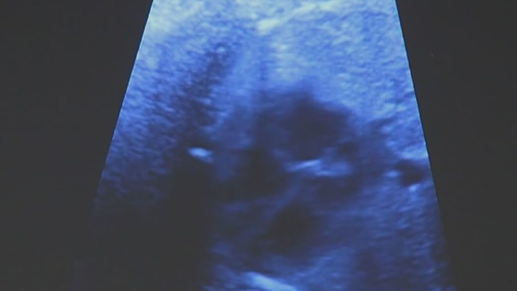 Gen Zers, Millennials twice as likely to develop hypertension in pregnancy