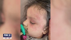 New eczema treatment approved for younger patients