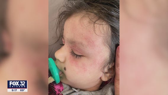 New eczema treatment approved for younger patients