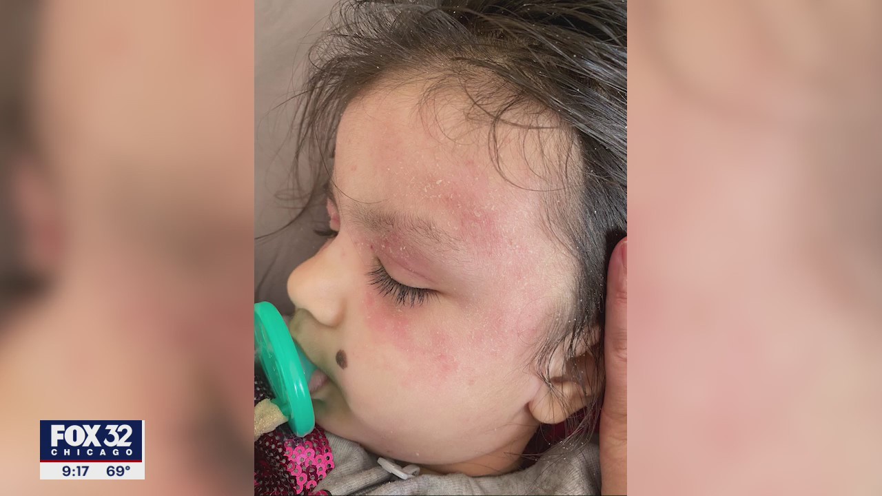 New eczema treatment approved for younger patients