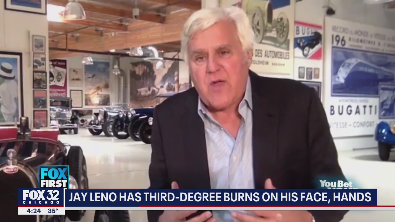 New details revealed after Jay Leno sustains third-degree burns on face, hands