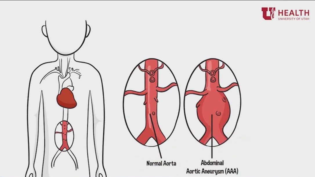 What are aortic aneurysms and who is most at risk?