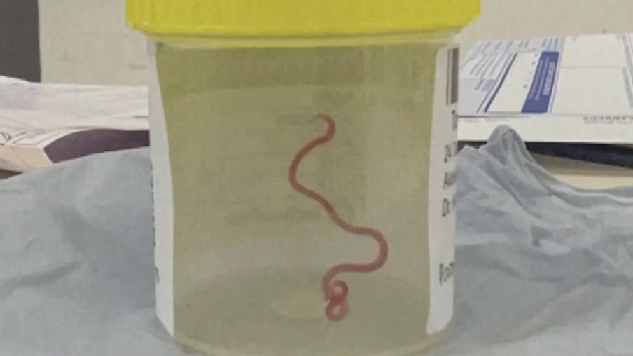 Neurosurgeon pulls worm out of woman's brain