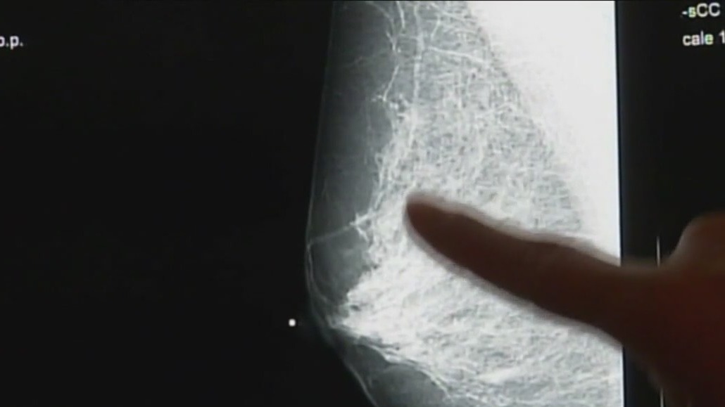 Learning the risks of breast cancer