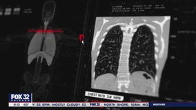 Young women facing higher lung cancer rates, puzzling scientists