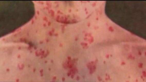 Growing concerns for migrants in Chicago after 2 cases of measles confirmed