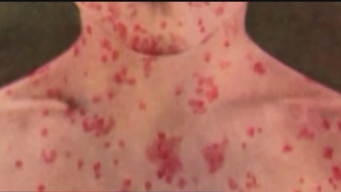Growing concerns for migrants in Chicago after 2 cases of measles confirmed