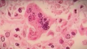 7 measles cases reported at Pilsen migrant shelter