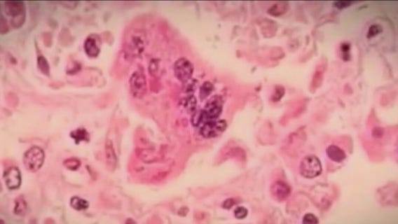 7 measles cases reported at Pilsen migrant shelter