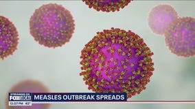 Measles outbreak: More than dozen states reported cases in 2024