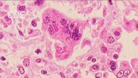 Measles cases on the rise across the U.S.