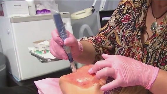 Vampire facials connected to HIV cases: CDC