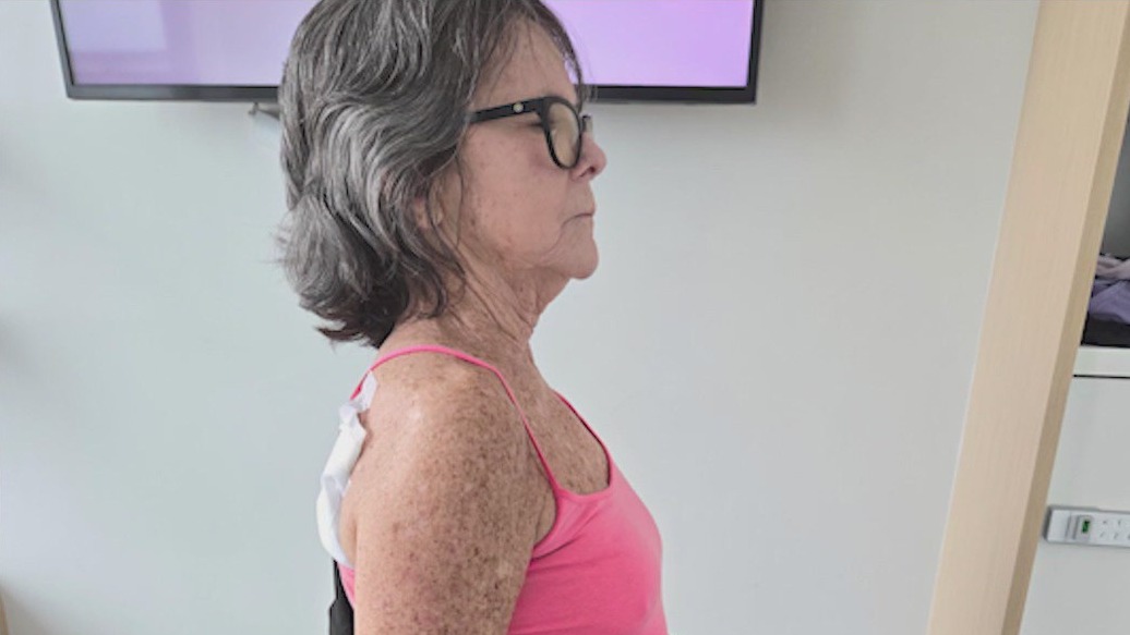 New spine surgery technology frees Indiana woman from years of back pain