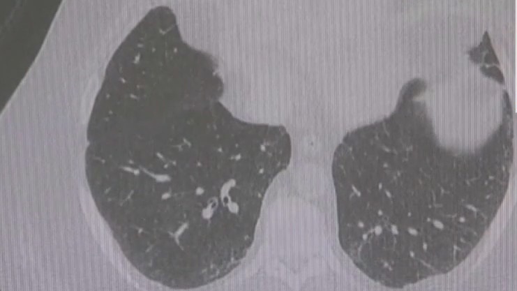 Early detection can be life-saving in a battle with lung cancer