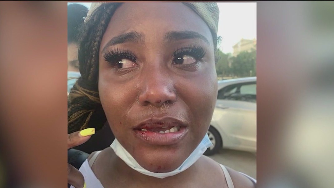 Chicago City Council OKs $280K settlement with activist struck by officer in 2020