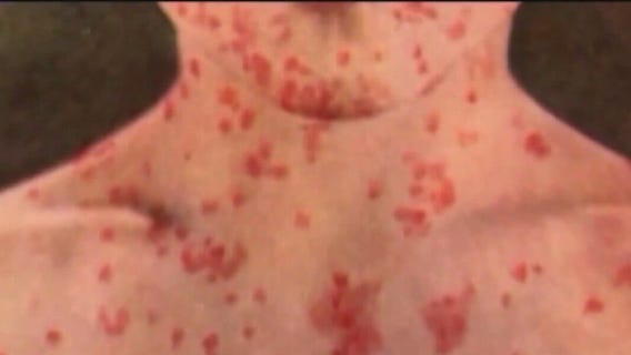 Measles in Cook County: Public exposure may have occurred at O?Hare