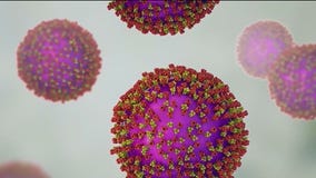 Measles cases confirmed in Chicago area