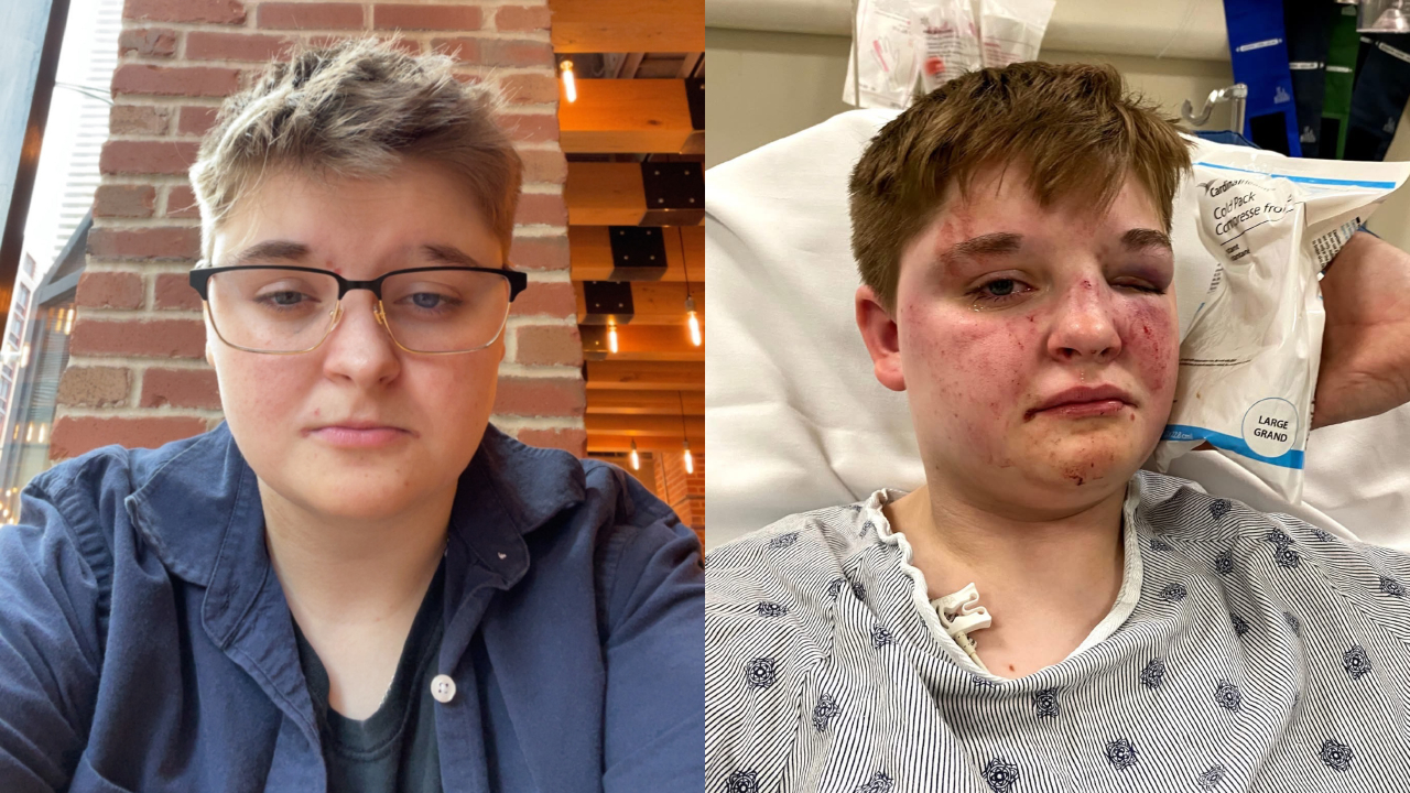 Victim of alleged homophobic attack in Carpentersville speaks out