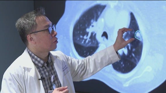 New AI tool used to help map lung tumors at Northwestern Medicine