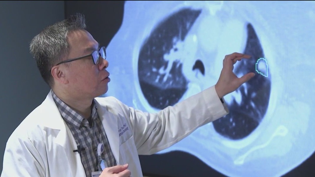 New AI tool used to help map lung tumors at Northwestern Medicine