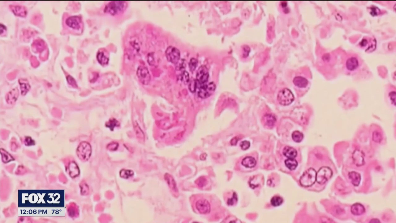 Illinois measles outbreak officially over