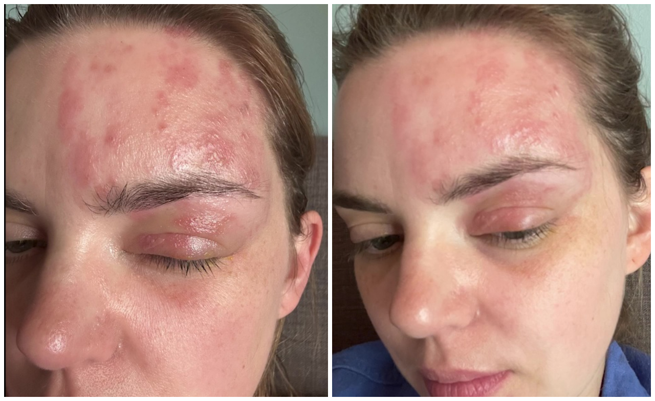 FOX 32 reporter shares painful shingles journey to warn others at risk