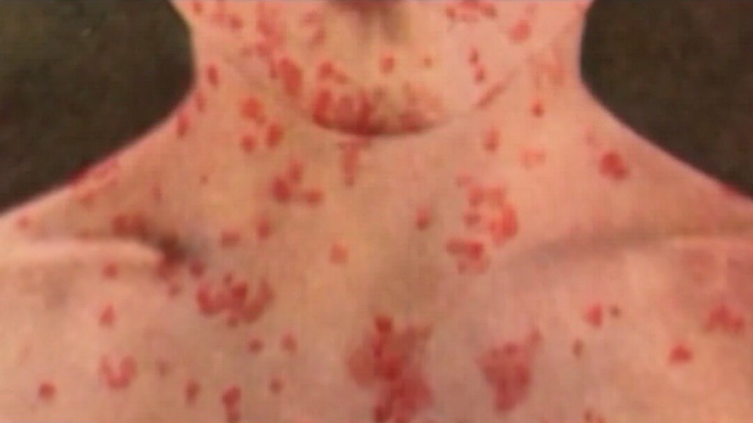 Measles exposure alert on Amtrak train through NYC