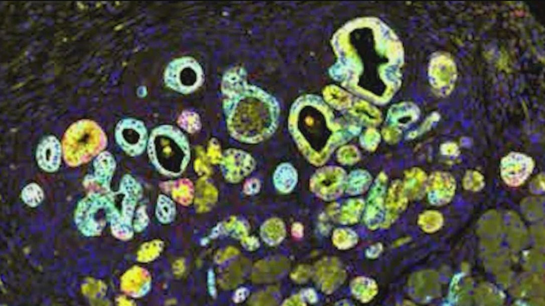 LI scientists make pancreatic cancer breakthrough