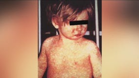 Some U.S. airports confirm having travelers with measles pass through
