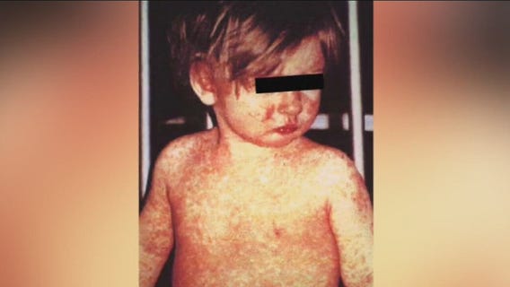 Some U.S. airports confirm having travelers with measles pass through