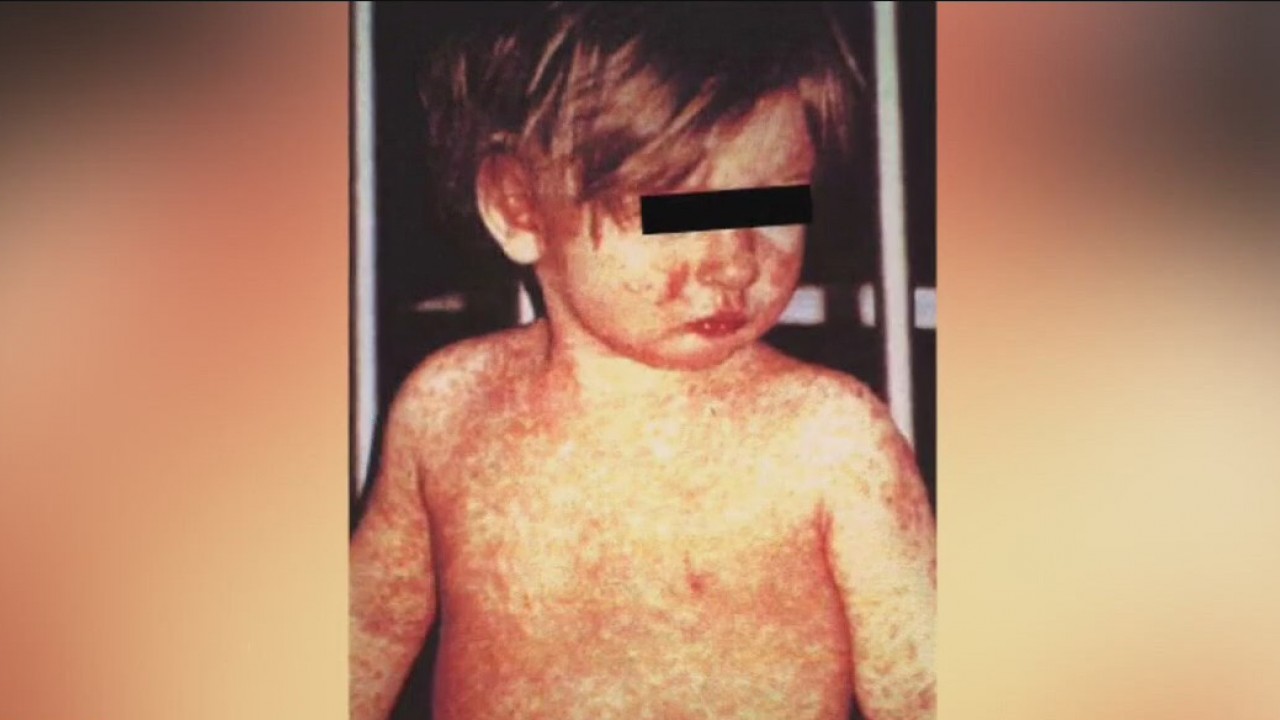 Some U.S. airports confirm having travelers with measles pass through