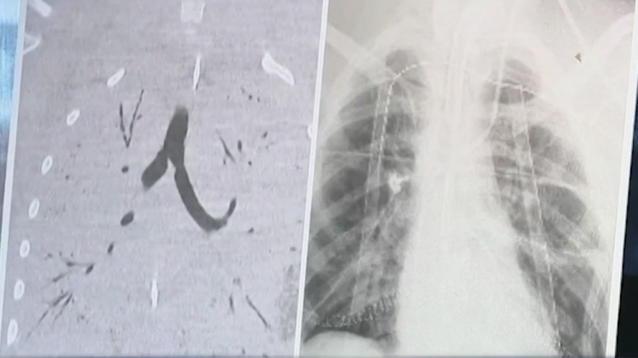 17-year-old undergoes double lung transplant, after lunge were damaged  by vaping