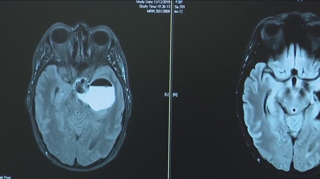 Woman undergoes brain surgery for tumor