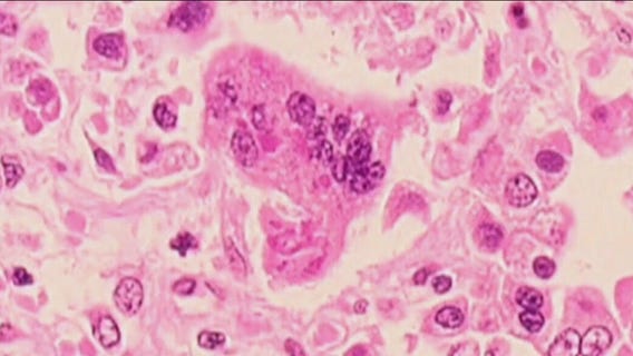 Tarrant Co. confirms 2 cases of measles
