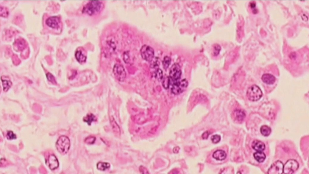 Tarrant Co. confirms 2 cases of measles