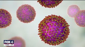 1st measles case confirmed in Dallas County