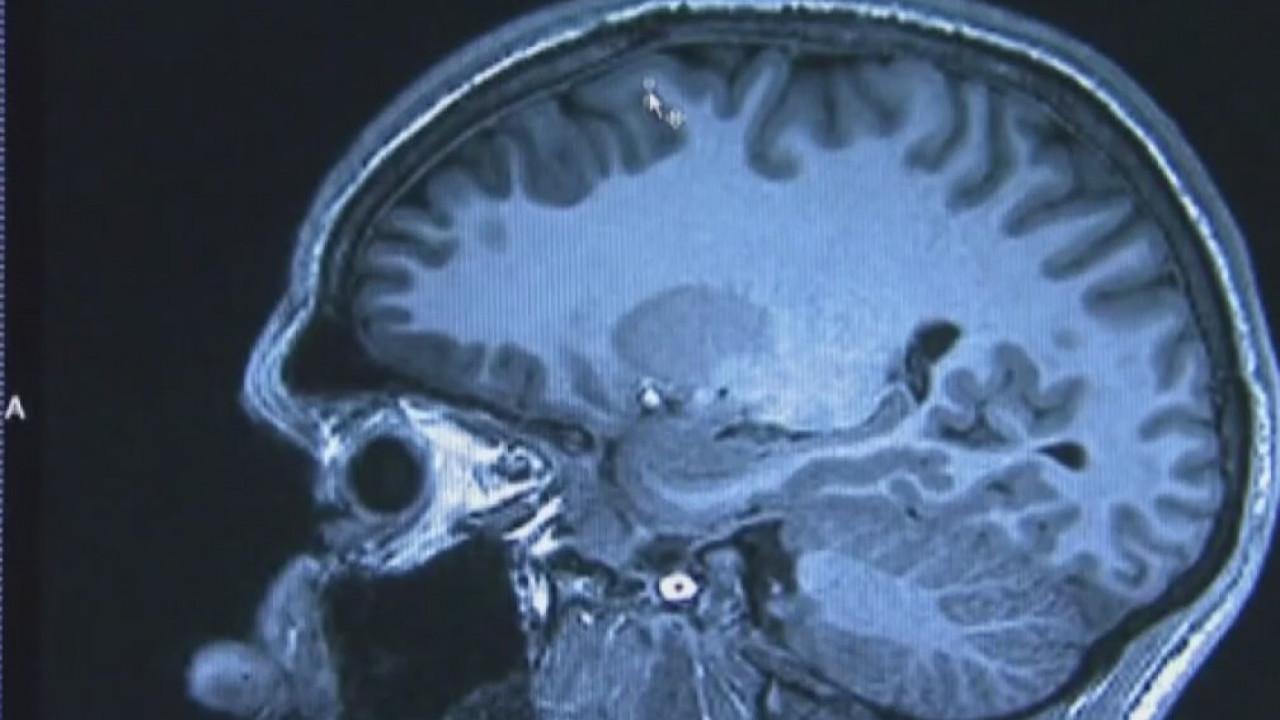 First blood test to help diagnose Alzheimer's disease goes on sale