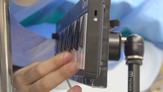 Texas musician plays piano while undergoing brain tumor surgery